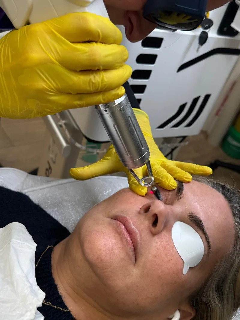 Close-up of a laser PMU removal session on a client's eyebrow area, with protective eye shield in place