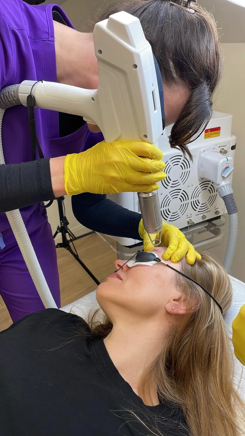 Linda performing a laser PMU removal treatment using a professional laser device at Defined by Linda in Clifton, Bristol